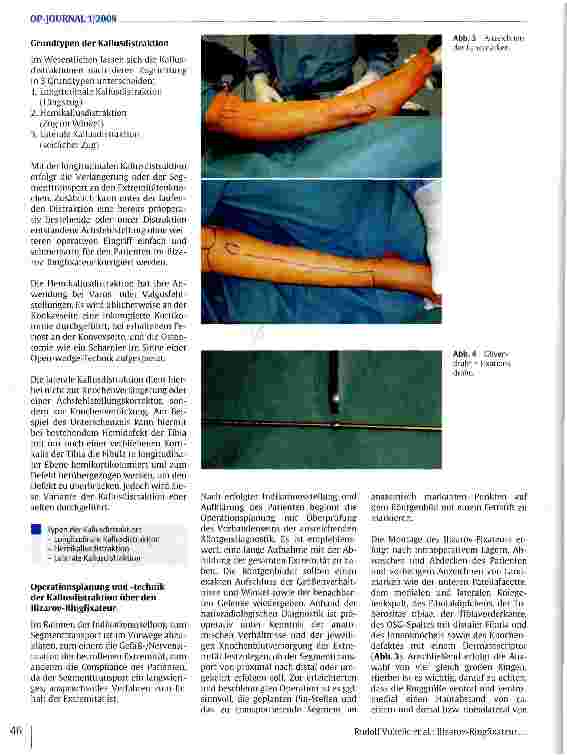 Vorschauseite 3: Ilizarov-Ringfixateur - ein Verfahren zur Kallusdistraktion