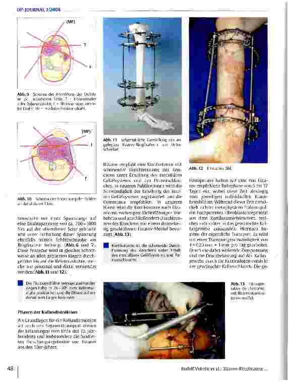 Vorschauseite 5: Ilizarov-Ringfixateur - ein Verfahren zur Kallusdistraktion