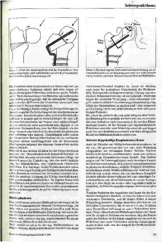 Vorschauseite 4: Hüftnahe Femurosteotomien