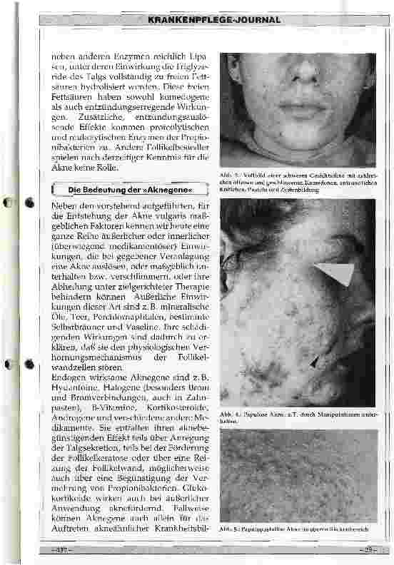 Vorschauseite 3: Ursachen, Klinik und Therapie der Akne vulgaris
