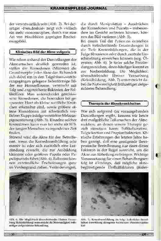 Vorschauseite 4: Ursachen, Klinik und Therapie der Akne vulgaris