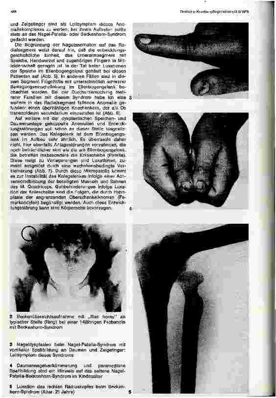 Vorschauseite 2: Das sogenannte Nagel-Patellaoder Beckenhorn-Syndrom