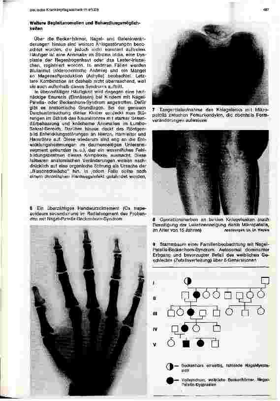 Vorschauseite 3: Das sogenannte Nagel-Patellaoder Beckenhorn-Syndrom