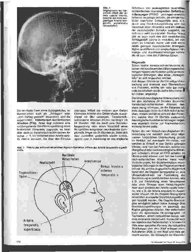 Vorschauseite 3: Themen aus der Neurochirurgie 18. Folge: Durchblutungsstörungen des Gehirns