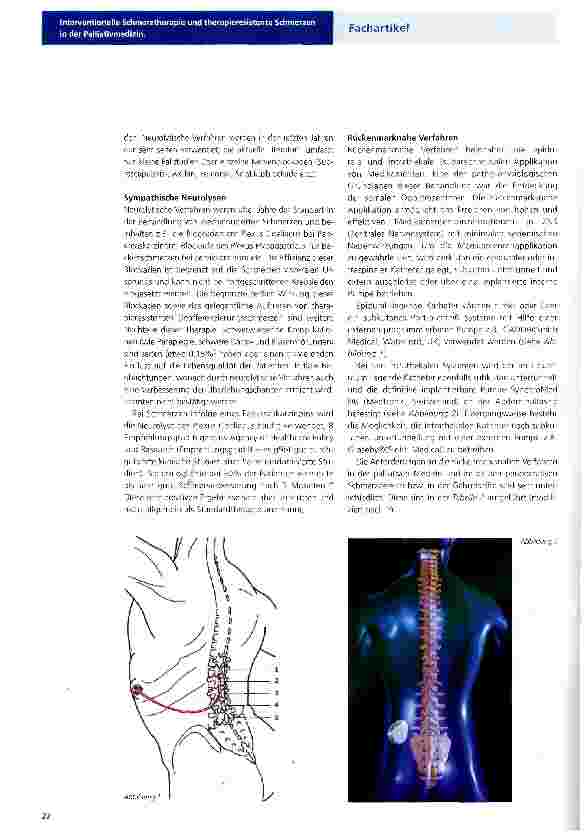 Vorschauseite 2: Interventionelle Schmerztherapie und therapieresistente Schmerzen in derPalliativmedizin.