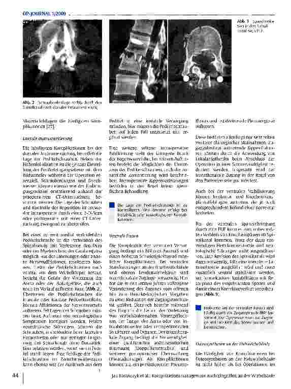 Vorschauseite 3: Komplikationsmanagement nach Eingriffen an der Wirbelsäule
