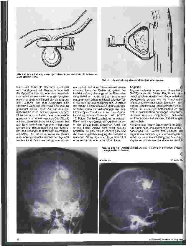 Vorschauseite 3: Themen aus der Neurochirurgie 17. folge Zerebrale Aneurysmen und Angiome