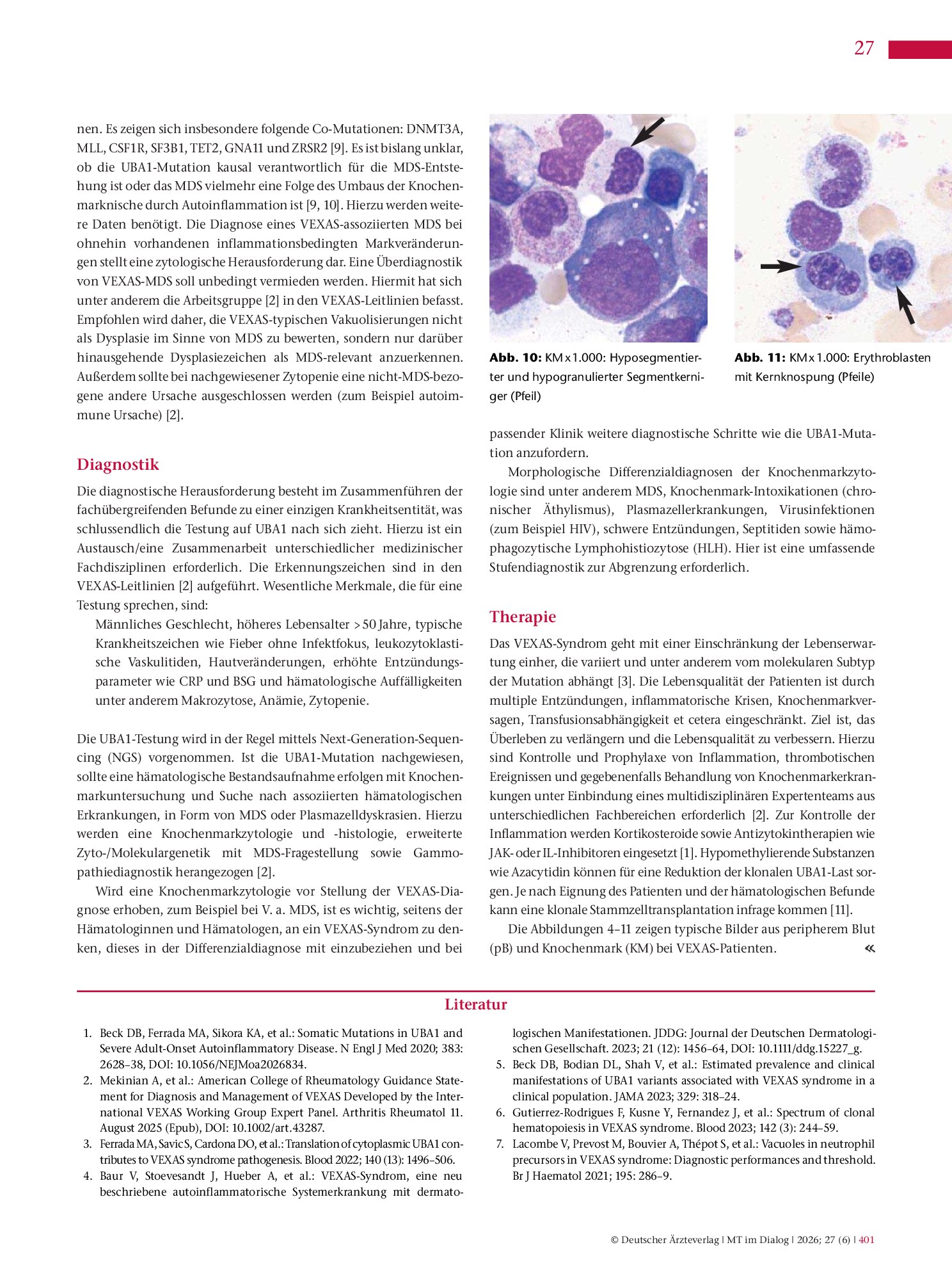 Vorschauseite 4: VEXAS-Syndrom: Eine Multisystemerkrankung mit hämatologischer Relevanz