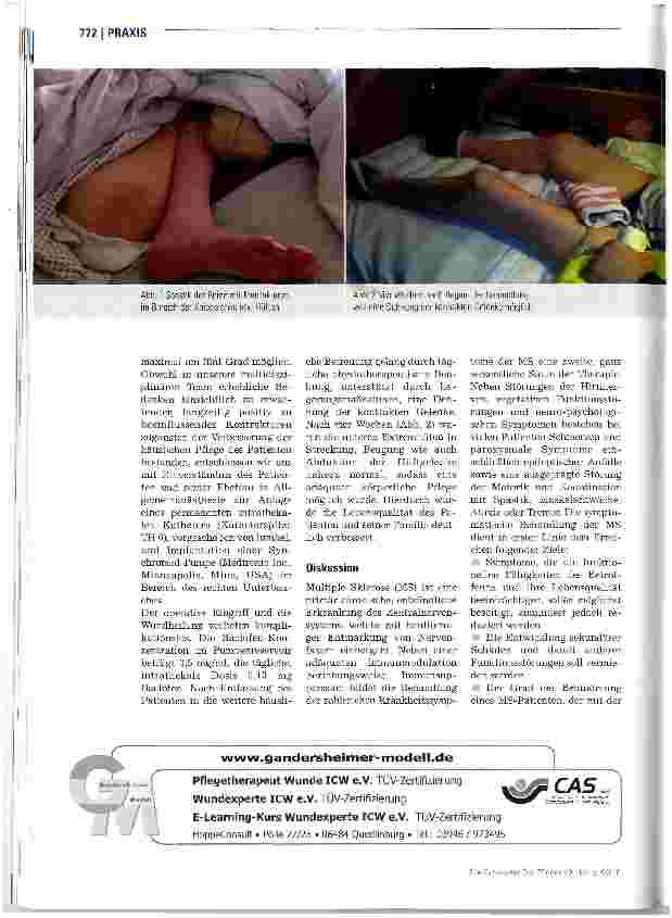 Vorschauseite 2: Intrathekale Therapie mit Baclofen bei MS mit Spastik