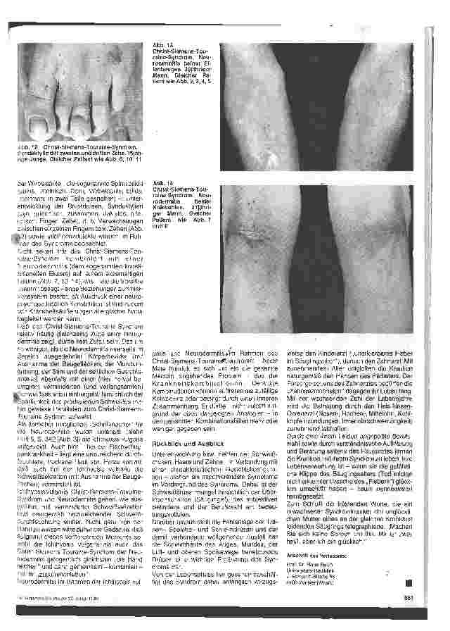 Vorschauseite 4: Hautärztliche Blick-Diagnose von Erbkrankheiten: Das Christ-Siemens-Touraine Syndrom