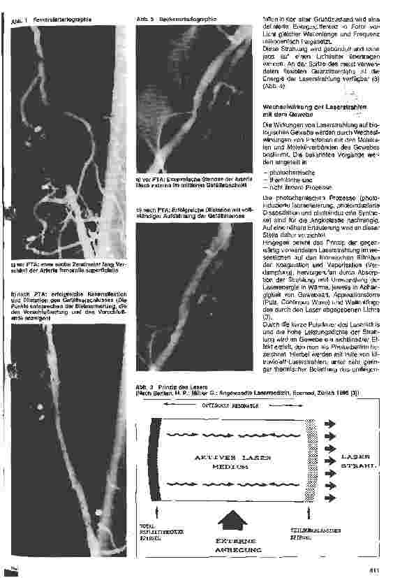 Vorschauseite 2: Einsatz von Lasern zur Behandlung von arteriosklerotischen Gefäßerkrankungen (Laserangioplastie)