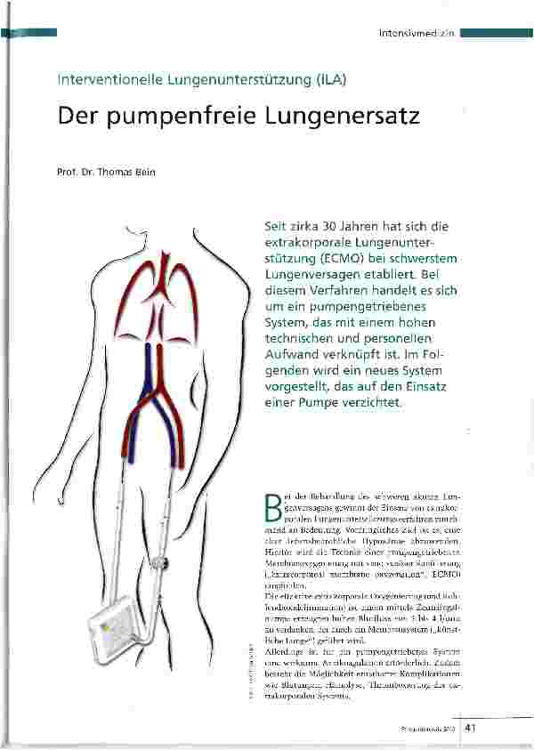 Vorschauseite 1: Der pumpenfreie Lungenersatz