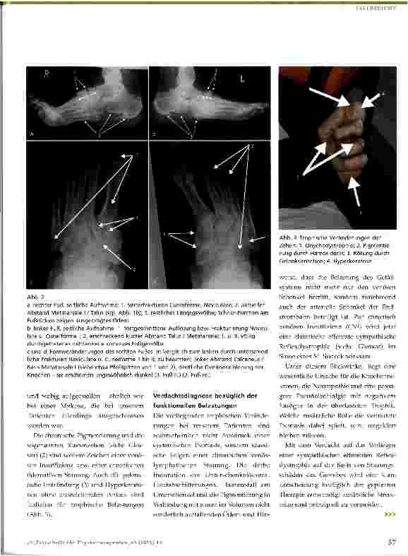 Vorschauseite 2: Kompressionsbehandlung bei Osteolyse