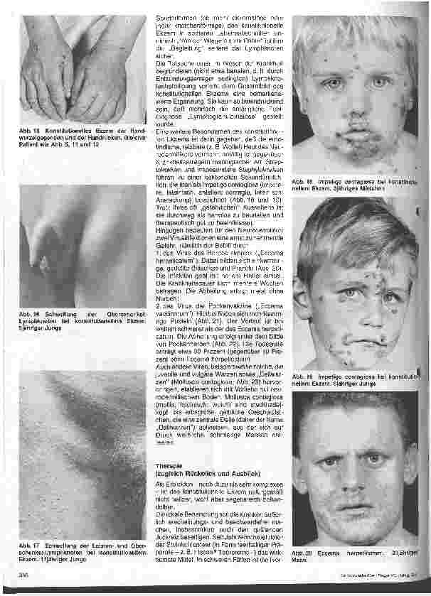 Vorschauseite 4: Hautärztliche Blick-Diagnose von Erbkrankheiten: Das konstitutionelle Ekzem