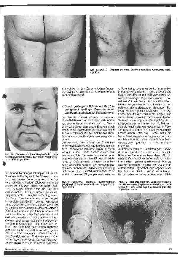 Vorschauseite 4: Hautärztliche Blick-Diagnose von Erbkrankheiten: Die Zuckerkrankheit
