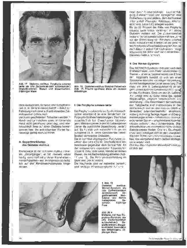 Vorschauseite 5: Hautärztliche Blick-Diagnose von Erbkrankheiten: Die Zuckerkrankheit