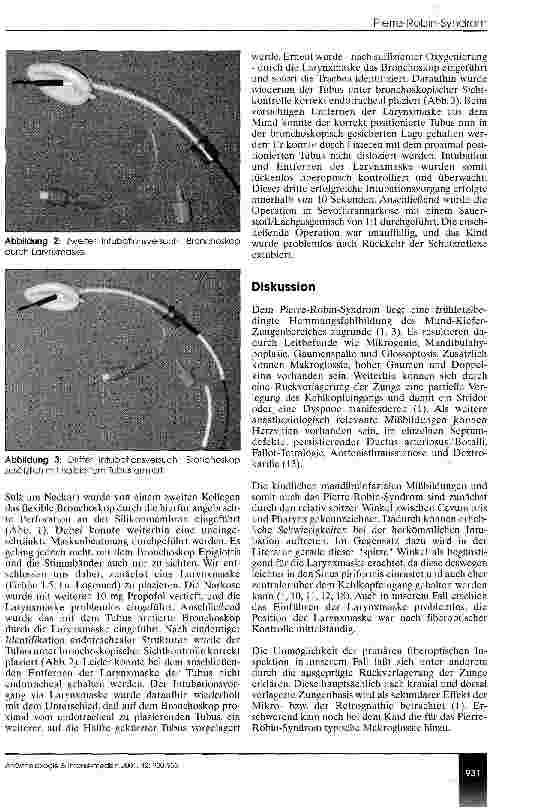 Vorschauseite 2: Die Kombination aus Larynxmaske und Bronchoskop zur endotrachealen Intubation beim kindlichen Pierre-Robin-Syndrom