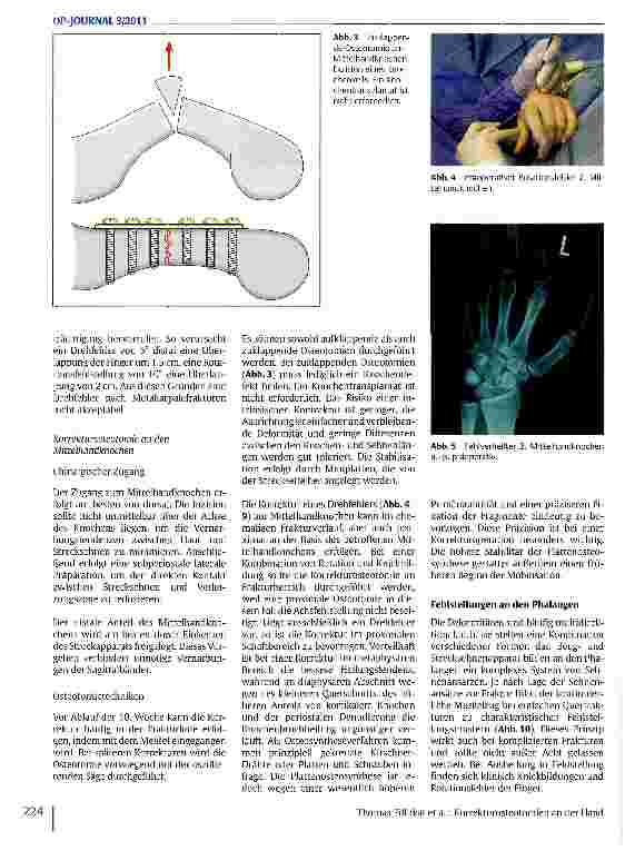 Vorschauseite 3: Korrekturosteotomien an der Hand