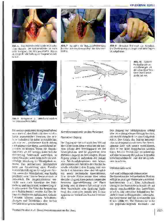 Vorschauseite 4: Korrekturosteotomien an der Hand