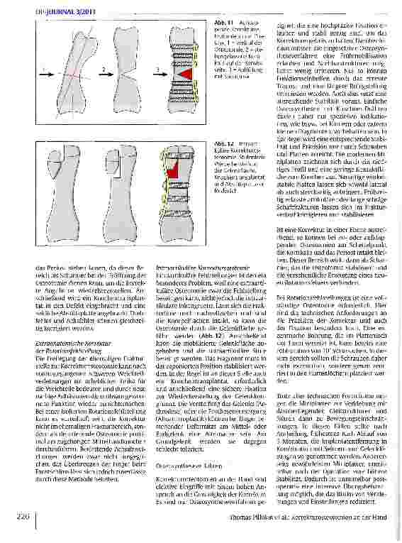 Vorschauseite 5: Korrekturosteotomien an der Hand