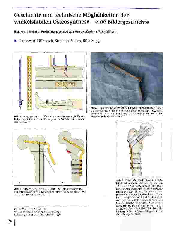 Vorschauseite 1: Geschichte und technische Möglichkeiten der winkelstabilen Osteosynthese - eine Bildergeschichte