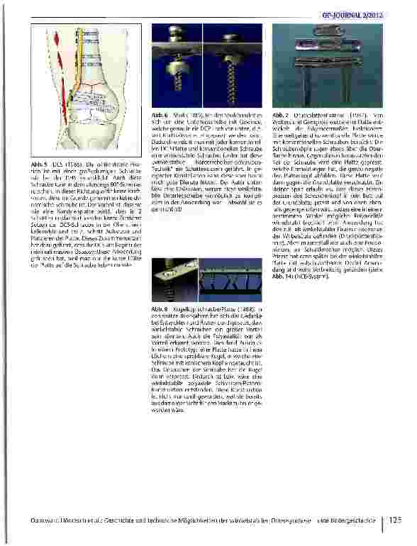 Vorschauseite 2: Geschichte und technische Möglichkeiten der winkelstabilen Osteosynthese - eine Bildergeschichte