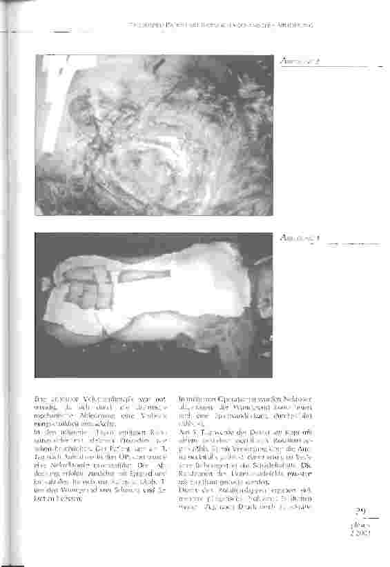 Vorschauseite 2: Fallbeispiel: Patient mit thermisch mechanischer Ablederung