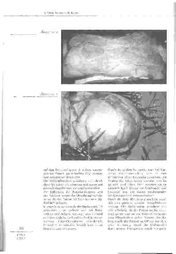 Vorschauseite 3: Fallbeispiel: Patient mit thermisch mechanischer Ablederung