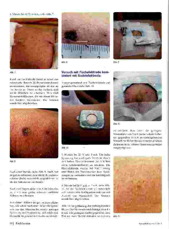 Vorschauseite 3: Risiken der Galvanotherapie (ECT/BET) bei Hauttumoren (benigne/ maligne) unter Verwendung von Nadelelektroden
