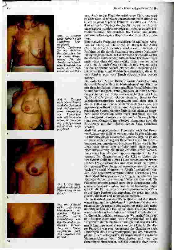 Vorschauseite 3: Die Problematik der Brustamputation und Rekonstruktion in der Tumorchirurgie