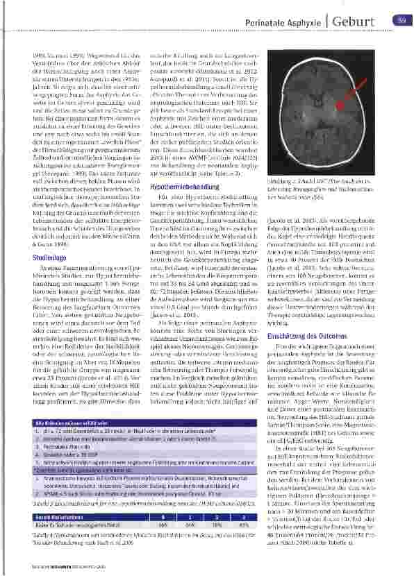 Vorschauseite 5: Perinatale Asphyxie Das Potenzial der Kühlung