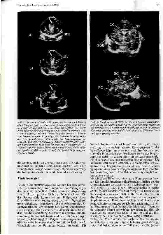 Vorschauseite 4: Echoenzephalographie beim Neugeborenen und Säugling