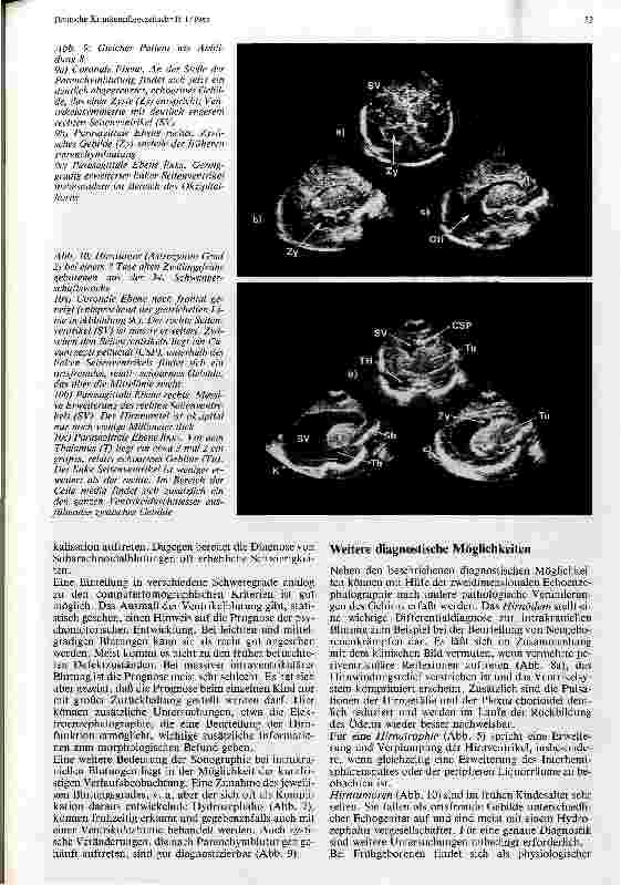 Vorschauseite 6: Echoenzephalographie beim Neugeborenen und Säugling