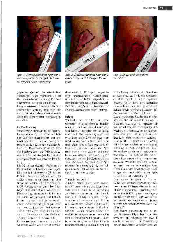 Vorschauseite 2: Reiztherapeutische Verödung eines wiederholten Rezidivs einer Schleimbeutel-Pseusozyste mit konzentrierter Milchsäure