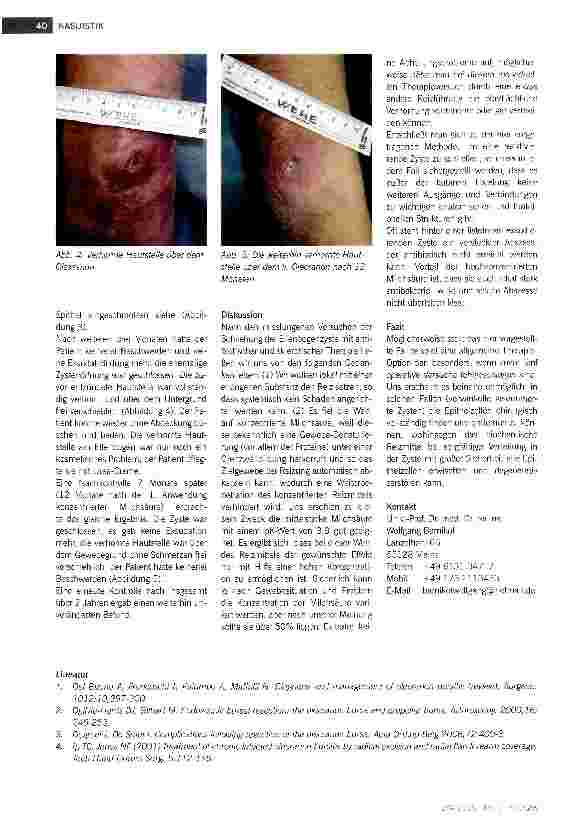 Vorschauseite 3: Reiztherapeutische Verödung eines wiederholten Rezidivs einer Schleimbeutel-Pseusozyste mit konzentrierter Milchsäure