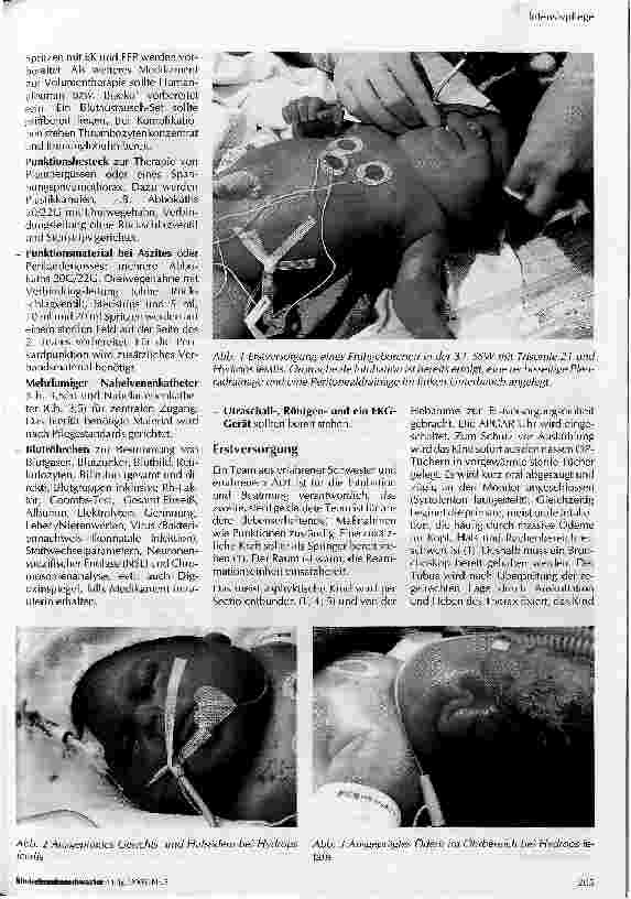 Vorschauseite 3: IntensivpflegePflege von Neugeborenen mit Hydrops fetalis