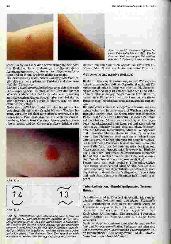 Vorschauseite 4: Tuberkulindiagnostik