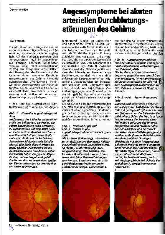 Vorschauseite 1: Augensymptome bei akuten arteriellen Durchblutungsstörungen des Gehirns