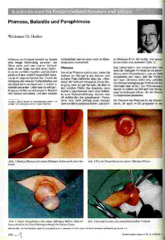 Vorschauseite 1: Phimose, Balanitis und Paraphimose