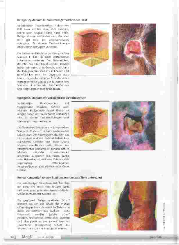 Vorschauseite 4: Dekubitus: wenn Druckgeschwüre Druck machen!