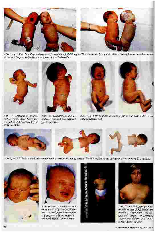 Vorschauseite 5: 25 Jahre Thalidomid-Embryopathie Rückbesinnung auf Arzneimittelrisiken