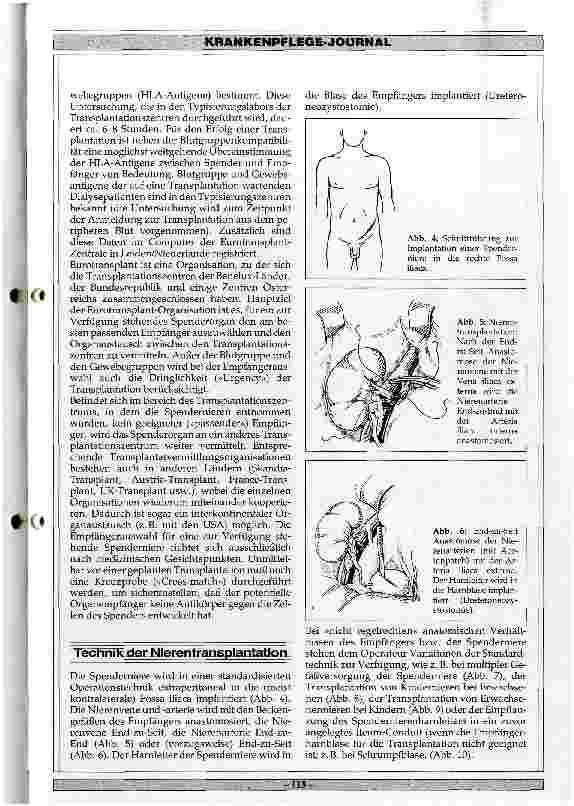 Vorschauseite 5: Nierentransplantationen 1987