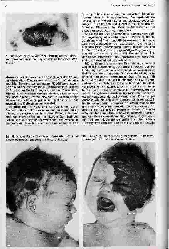 Vorschauseite 2: Hämangiome, Feuermale und Pigmentzellwucherungen