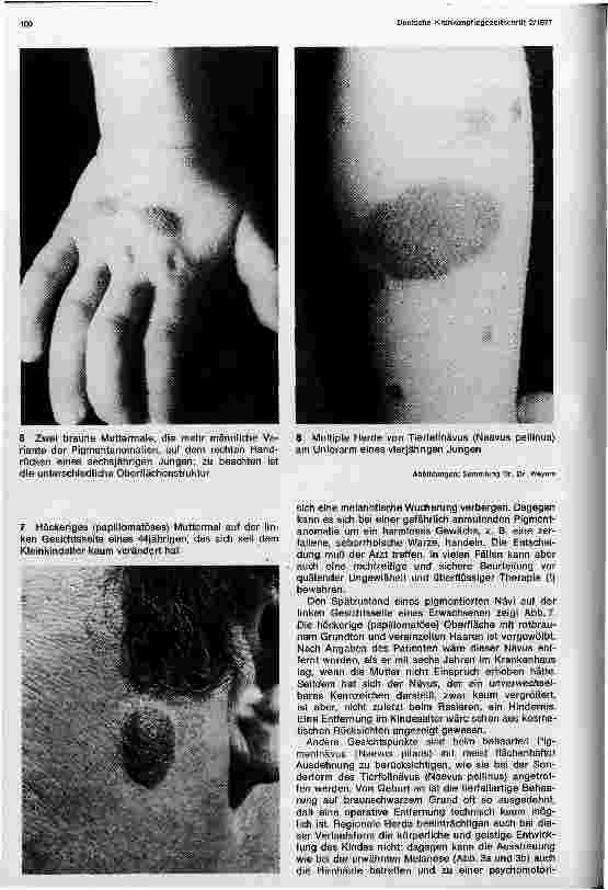 Vorschauseite 4: Hämangiome, Feuermale und Pigmentzellwucherungen