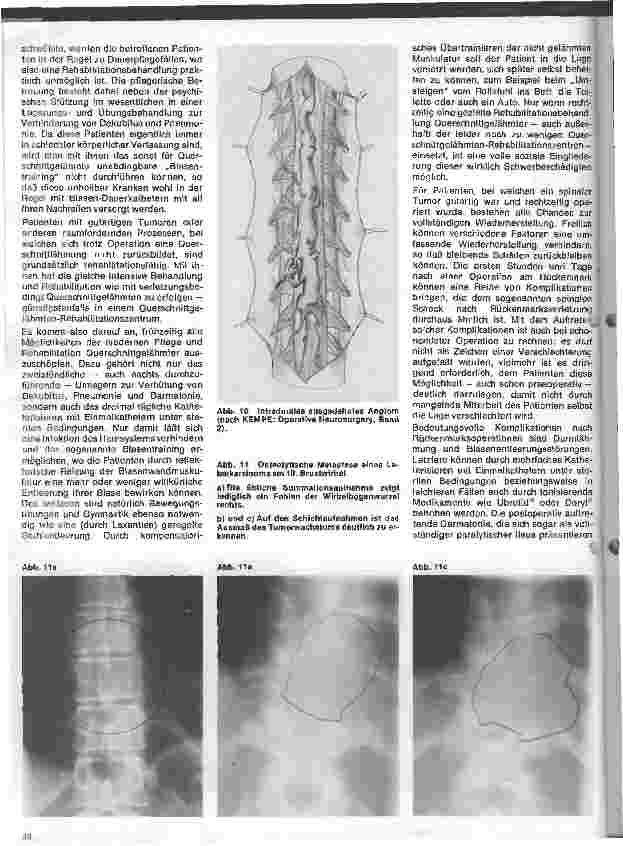 Vorschauseite 5: Themen aus der Neurochirurgie 6. Folge: Spinale Tumoren