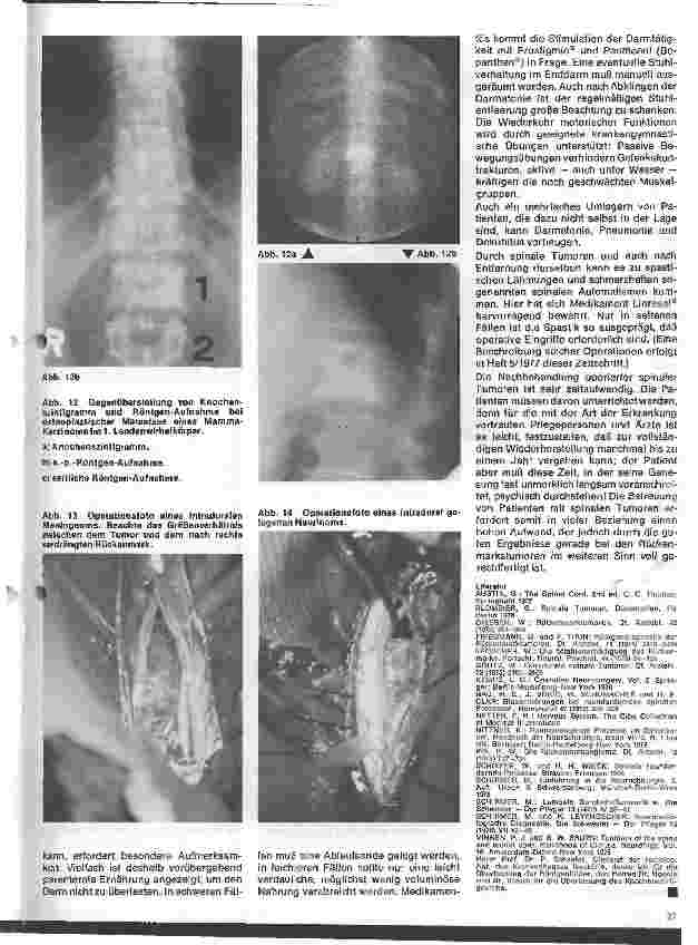 Vorschauseite 6: Themen aus der Neurochirurgie 6. Folge: Spinale Tumoren