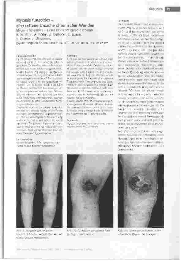 Vorschauseite 1: KASUISTIK Mycosis fungoides - eine seltene Ursache chronischer Wunden