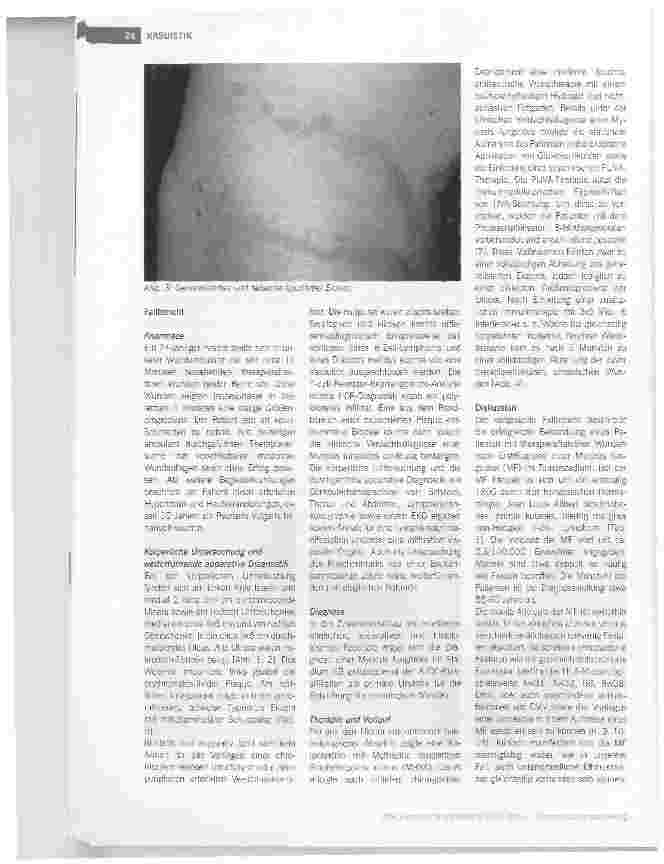 Vorschauseite 2: KASUISTIK Mycosis fungoides - eine seltene Ursache chronischer Wunden