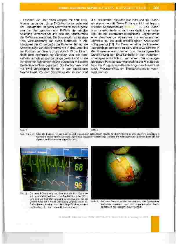 Vorschauseite 2: Minimal invasive und EKG-unterstützte Platzierung eines venösen Portkathetersystems