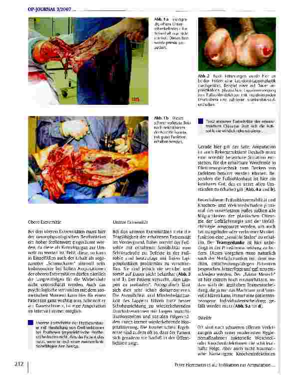 Vorschauseite 3: Die Indikation zur Amputation in der modernen Traumatologie und septischen Knochenchirurgie